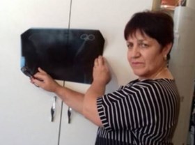 Russische vrouw loopt 23 jaar rond met chirurgische klem in maag