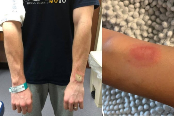Flinke brandwonden door Fitbit; is het dragen van een sporthorloge gevaarlijk?