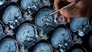 Onderzoek met Maastrichts tintje bewijst: driekwart van epilepsiepatiënten aanvalsvrij na operatie 