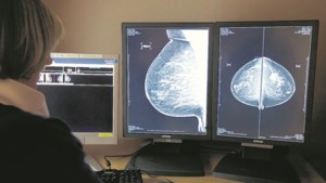 Bevolkingsonderzoek naar borstkanker herstart binnenkort in Chevremont