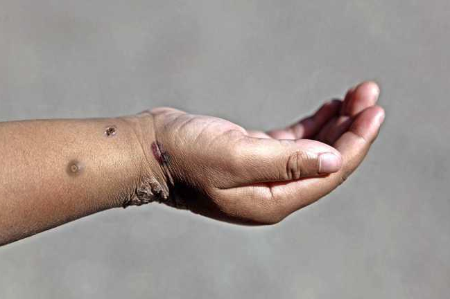 Number of monkey pox cases in Europe triples in two weeks